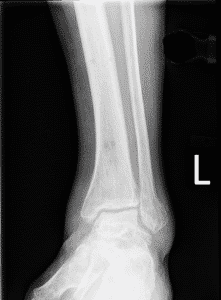 Xray Markers Origins Proper Use And Examples