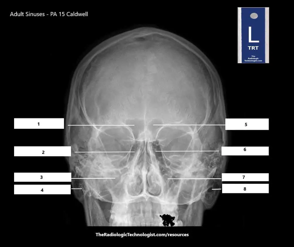 Blank - Adult Sinuses - PA 15 Caldwell