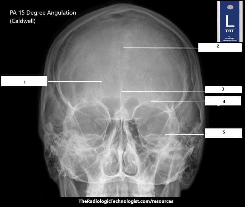 Blank - Adult Skull PA 15 Degree Angulation (Caldwell)