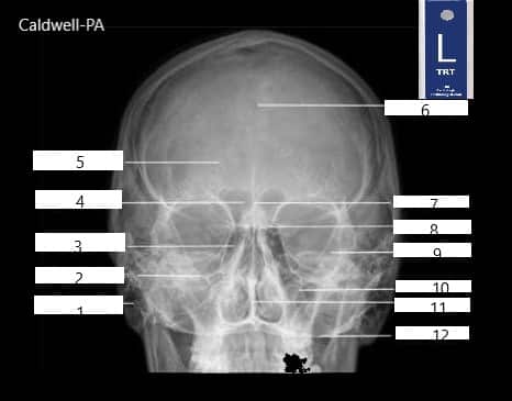 Blank - Caldwell-PA-Radiologic-Technologist-Anatomy