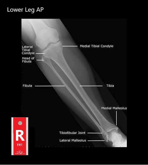 Student Study Guide: Lower Leg Anatomy
