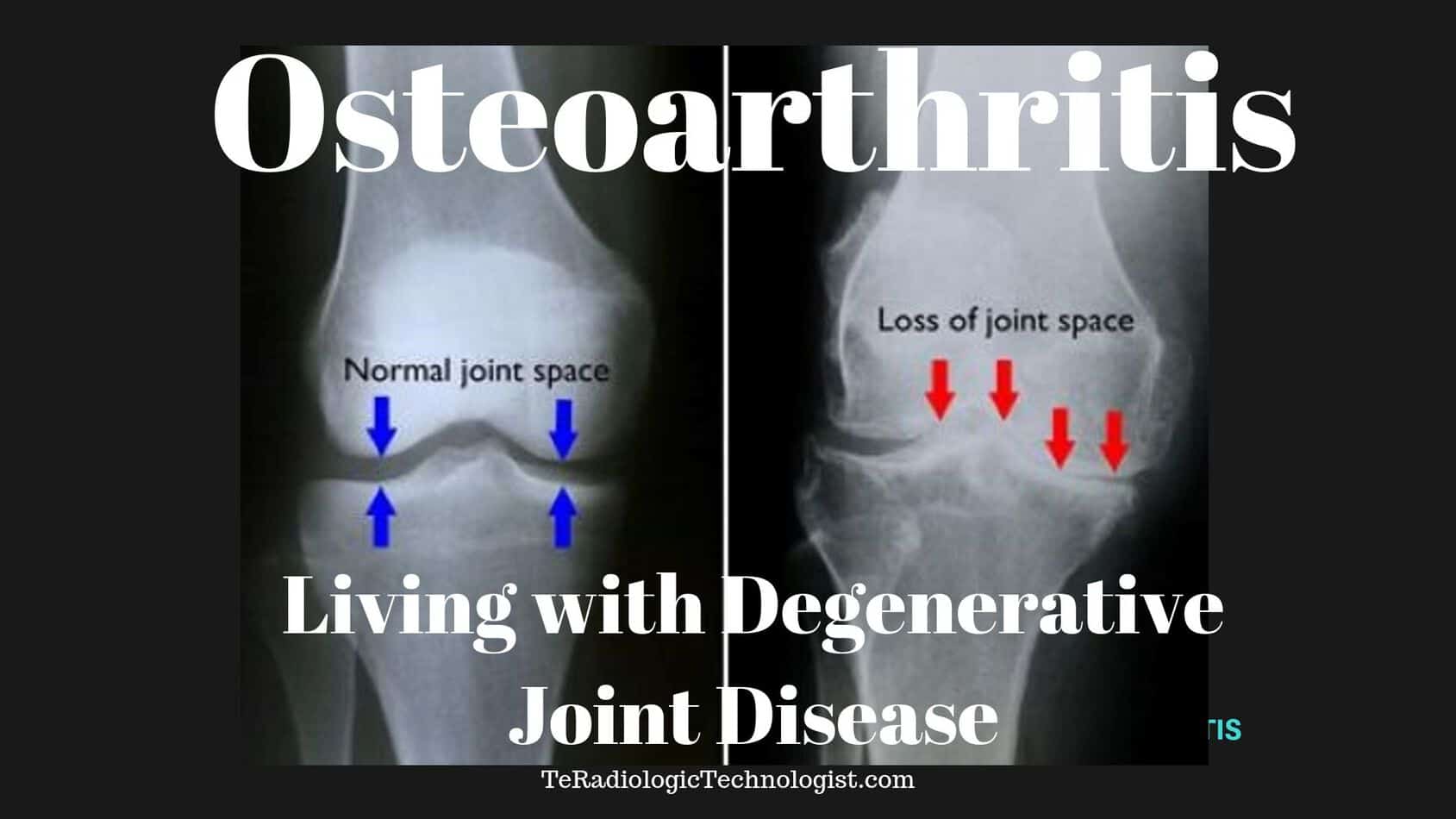 Osteoarthritis X Rays