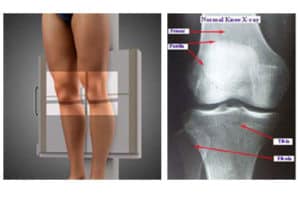 knee-ap-view-weight-bearing