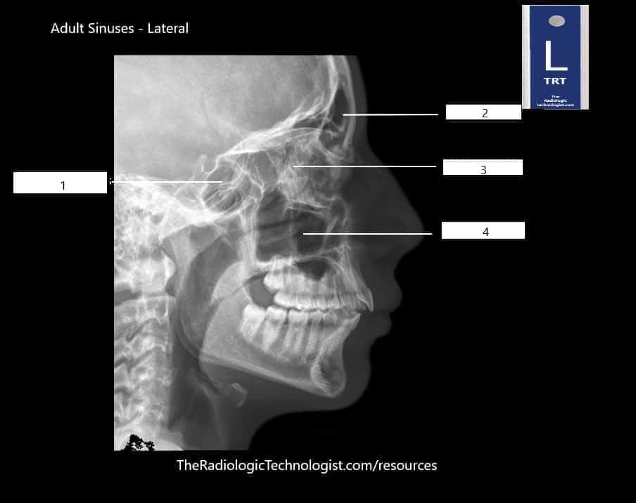 Blank-Adult-Sinuses-Lateral