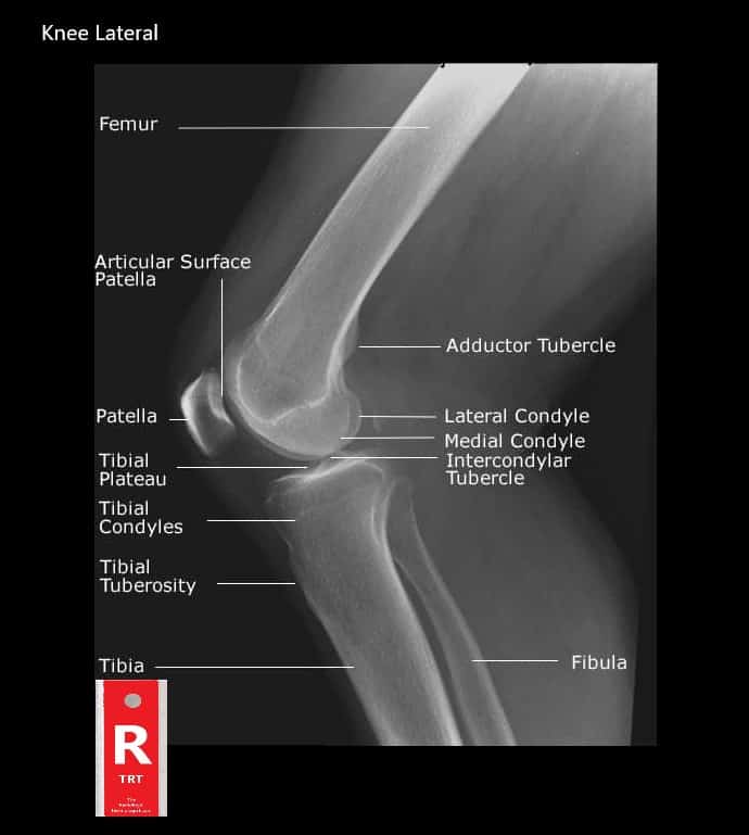 Normal Knee Xray - Knee Joint Anatomy - Knee Replacement ...