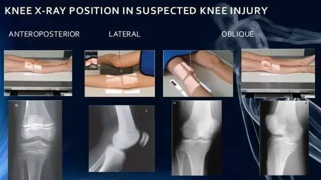 normal knee xray positions
