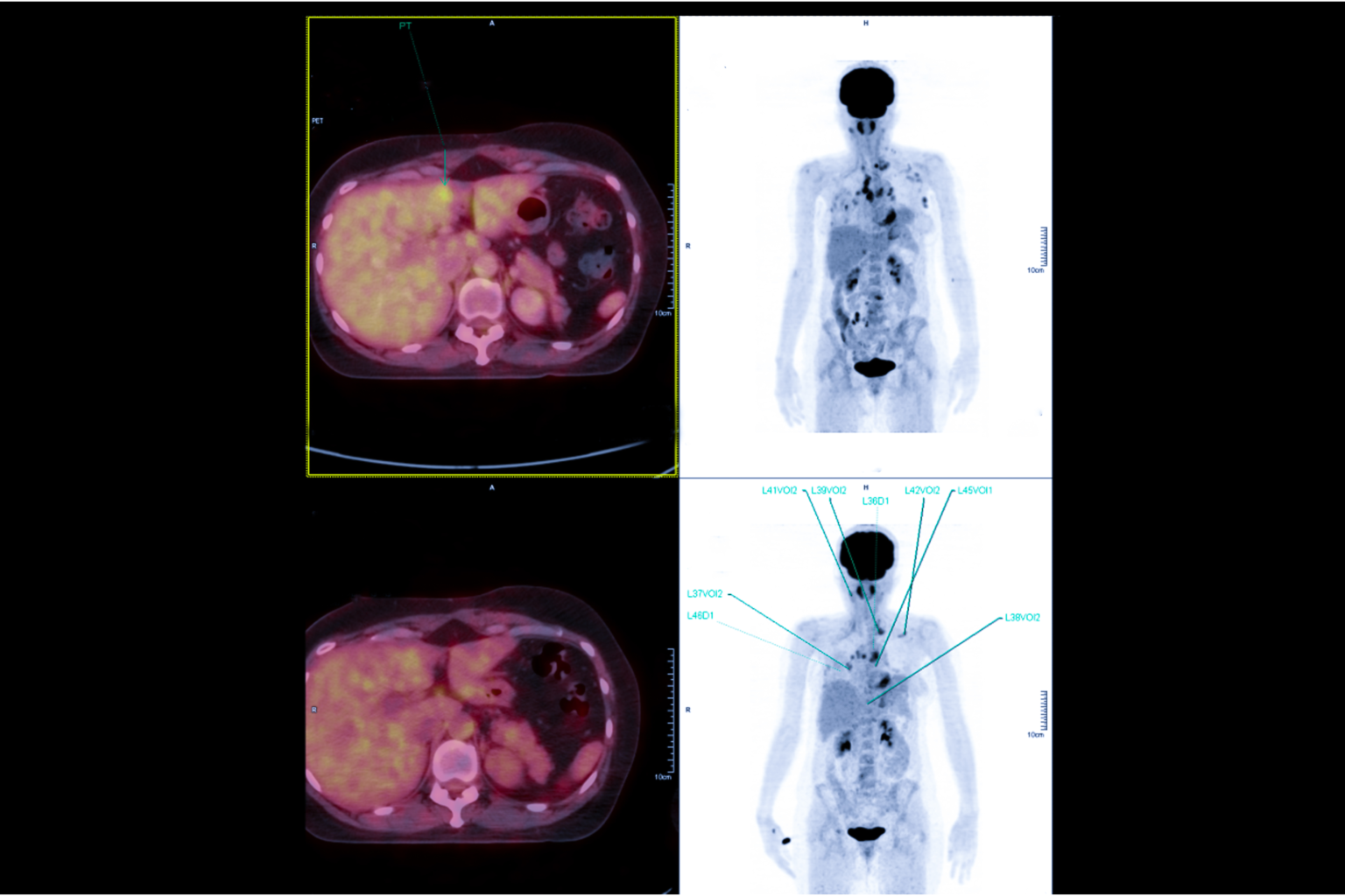 AP Axial Towne and PA Axial Haas Methods in Skull Radiography