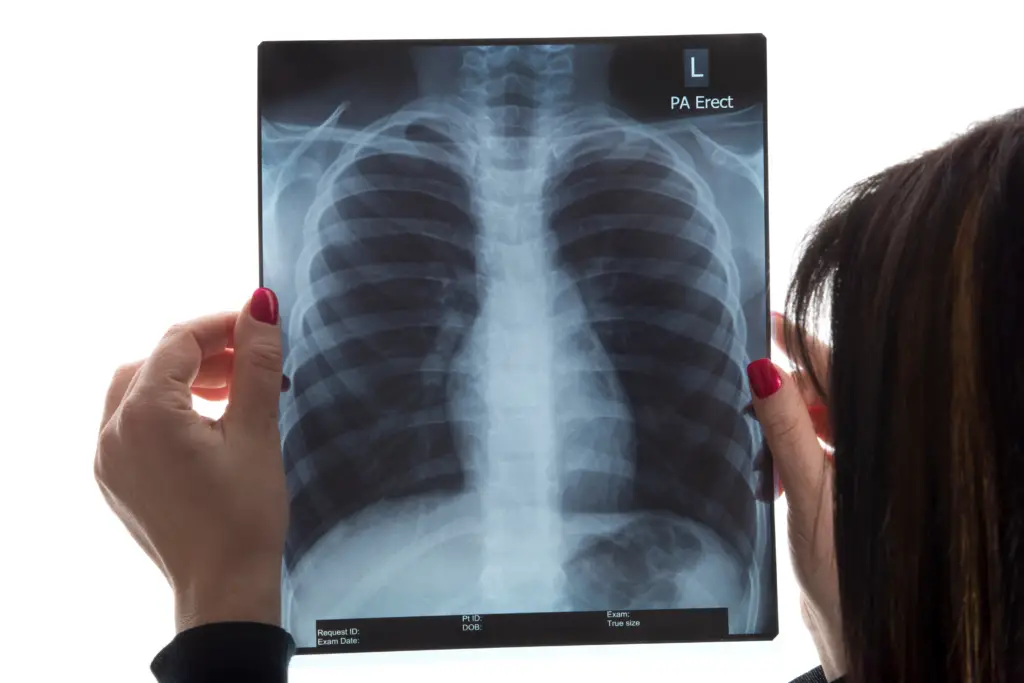 Essentials of Chest Radiography