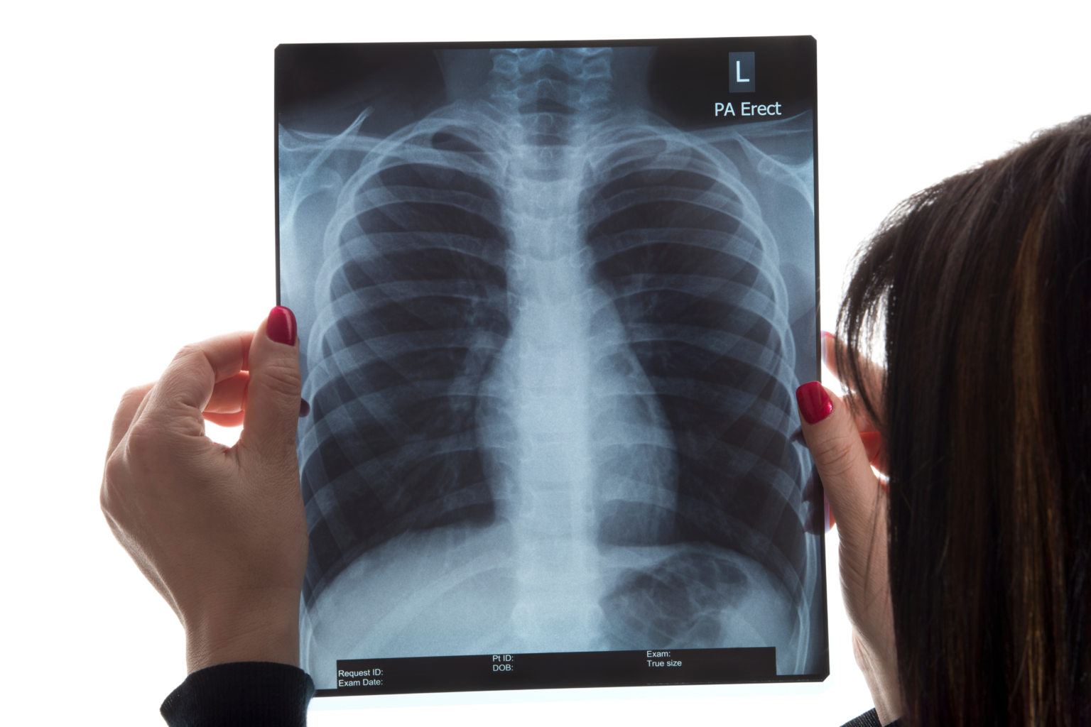 The Essentials of Chest Radiography: An Overview